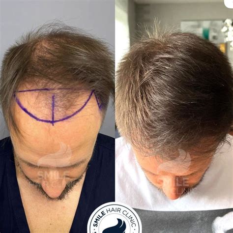 Fixhair Clinic Hakkında & Yorumları .